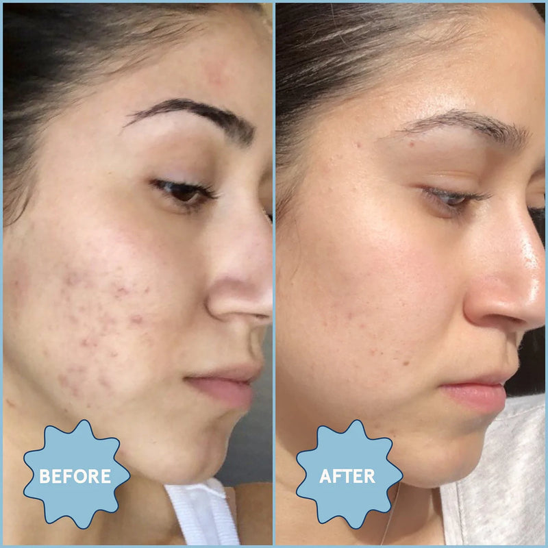Meltdown Acne Serum